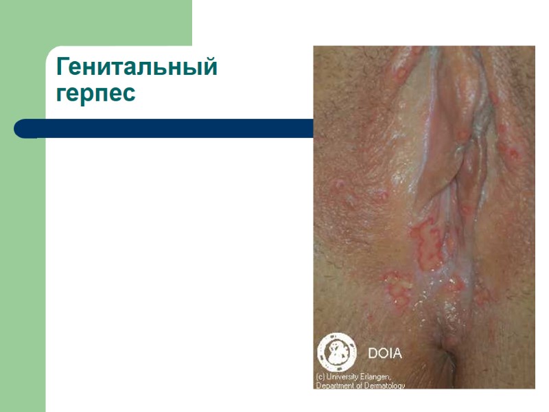 Генитальный герпес